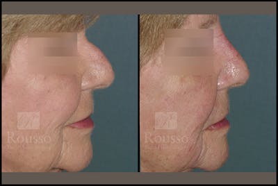Fillers Before & After Gallery - Patient 4412638 - Image 1