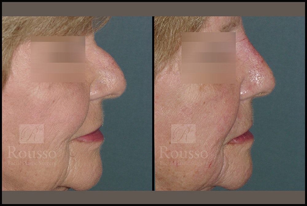 Fillers Gallery Before & After Gallery - Patient 4412638 - Image 1