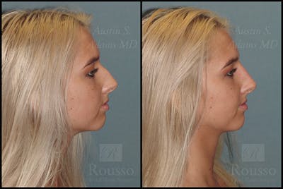Fillers Before & After Gallery - Patient 4412639 - Image 1