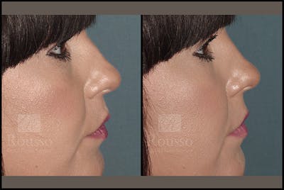 Fillers Before & After Gallery - Patient 4412640 - Image 1