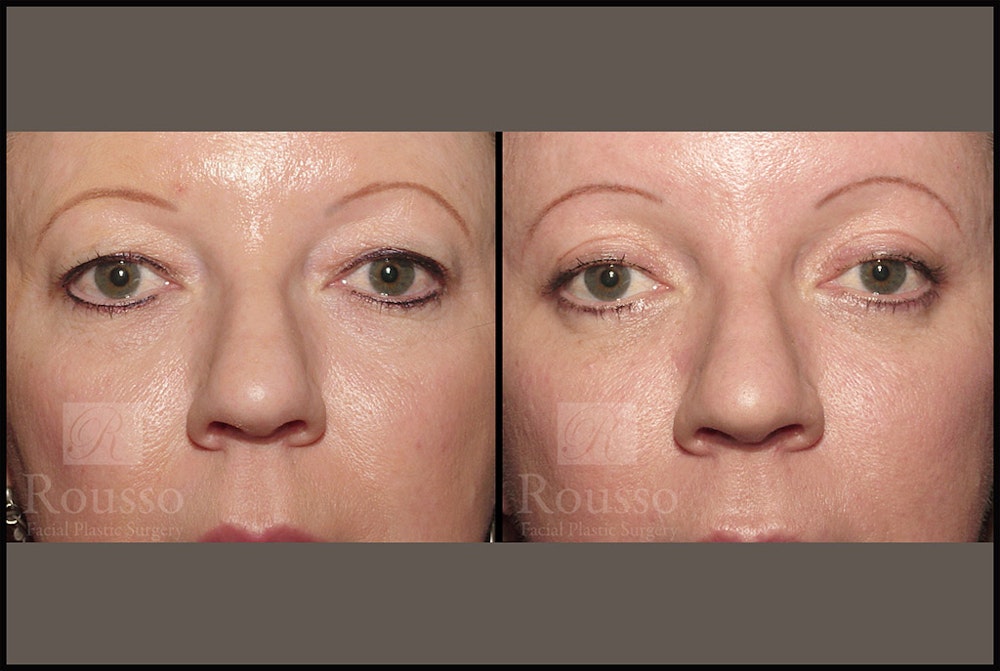 Blepharoplasty Before & After Gallery - Patient 4488733 - Image 1