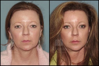 MiniLift <span class=small>By Dr. Daniel Rousso</span> Before & After Gallery - Patient 4488737 - Image 1