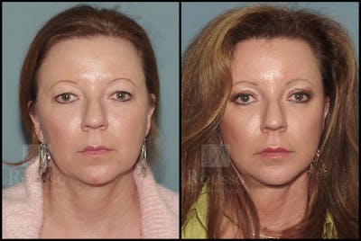 MiniLift Before & After Gallery - Patient 4488737 - Image 1