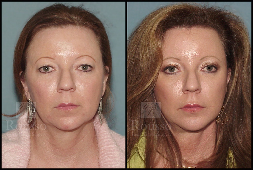 MiniLift <span class=small>By Dr. Daniel Rousso</span> Before & After Gallery - Patient 4488737 - Image 1
