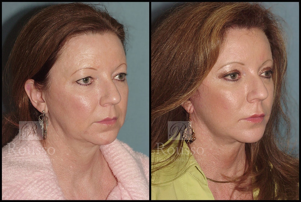MiniLift <span class=small>By Dr. Daniel Rousso</span> Before & After Gallery - Patient 4488737 - Image 2