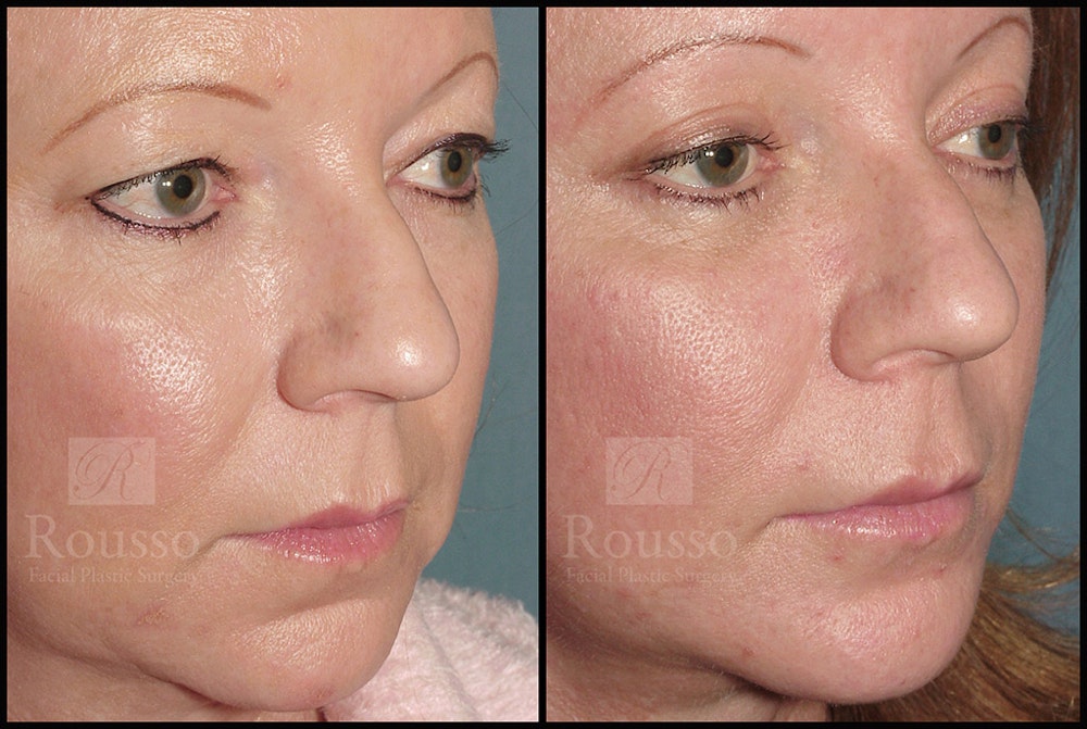 MiniLift Before & After Gallery - Patient 4488737 - Image 3