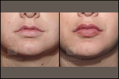 Fillers Gallery Before & After Gallery - Patient 4488744 - Image 1