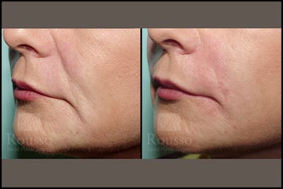 Fillers Gallery Before & After Gallery - Patient 4488744 - Image 2