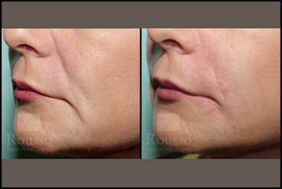 Fillers Before & After Gallery - Patient 4488744 - Image 2