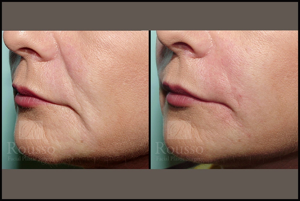 Fillers Before & After Gallery - Patient 4488744 - Image 2