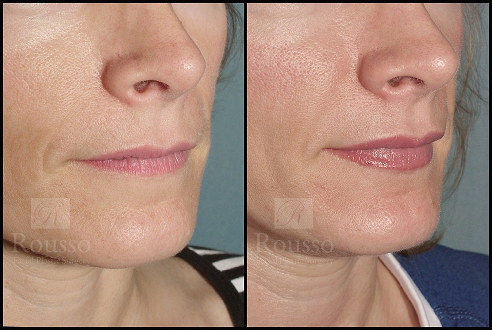 Fillers Before & After Gallery - Patient 4488745 - Image 1