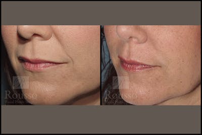 Fillers Before & After Gallery - Patient 4488746 - Image 1