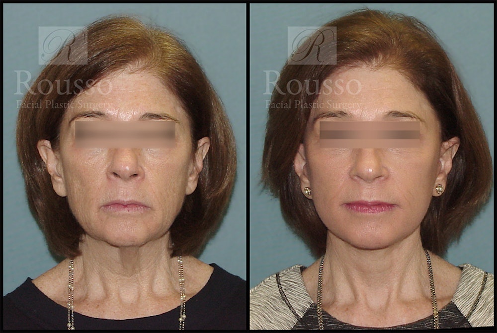 Facelift Before & After Gallery - Patient 4528692 - Image 3