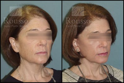 Facelift Before & After Gallery - Patient 4528692 - Image 1