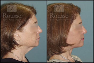 Facelift Before & After Gallery - Patient 4528692 - Image 2