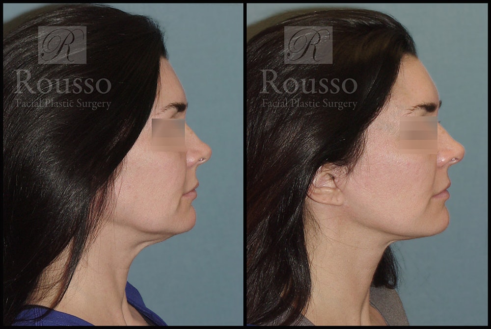 MiniLift <span class=small>By Dr. Daniel Rousso</span> Before & After Gallery - Patient 4528689 - Image 3