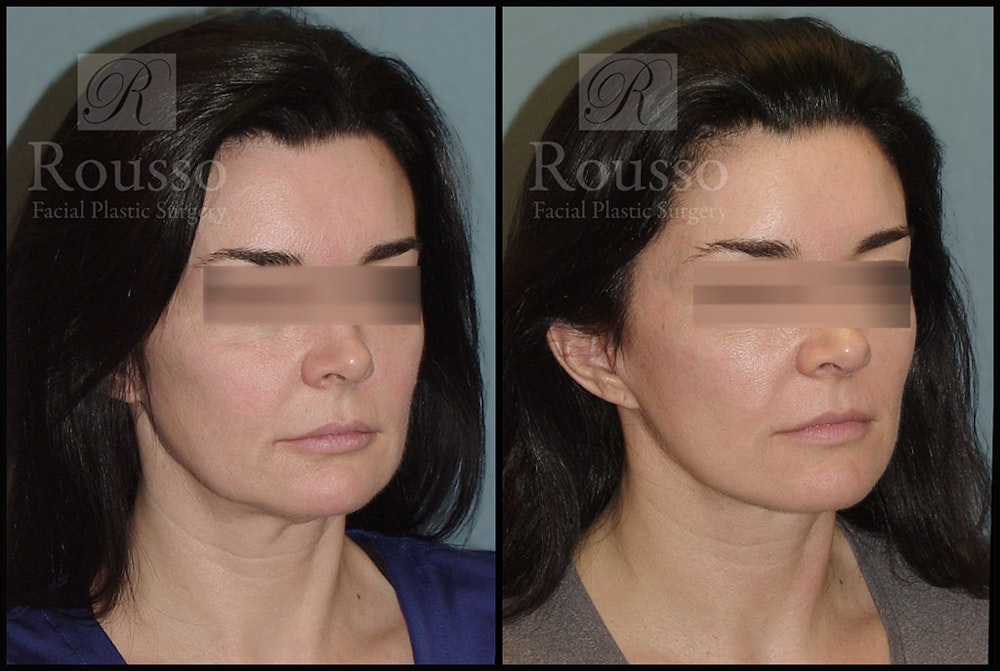 MiniLift Before & After Gallery - Patient 4528689 - Image 2