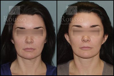 MiniLift Before & After Gallery - Patient 4528689 - Image 1