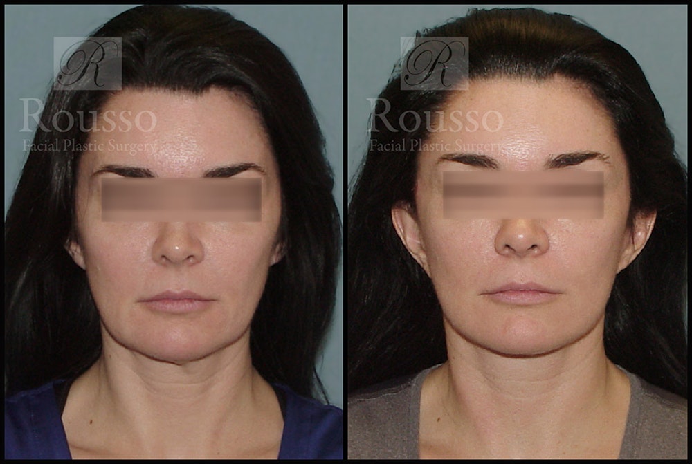 MiniLift Before & After Gallery - Patient 4528689 - Image 1