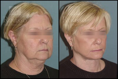 Facelift Before & After Gallery - Patient 2236589 - Image 1
