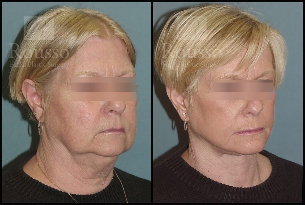 Facelift Before & After Gallery - Patient 2236589 - Image 1