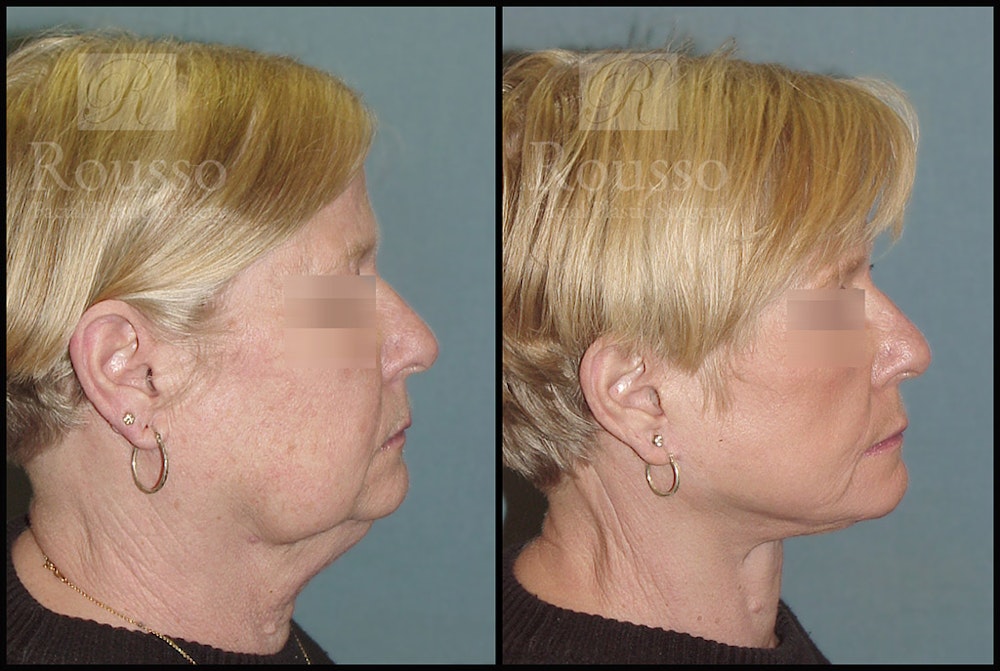Facelift Before & After Gallery - Patient 2236589 - Image 2