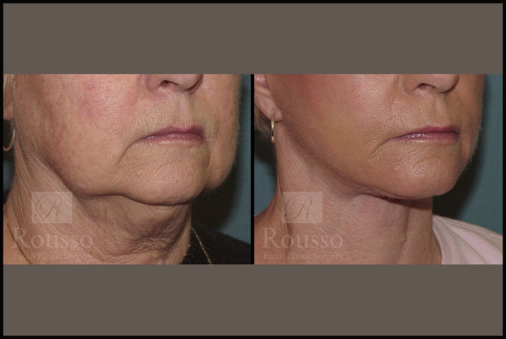 Facelift Before & After Gallery - Patient 2236589 - Image 3