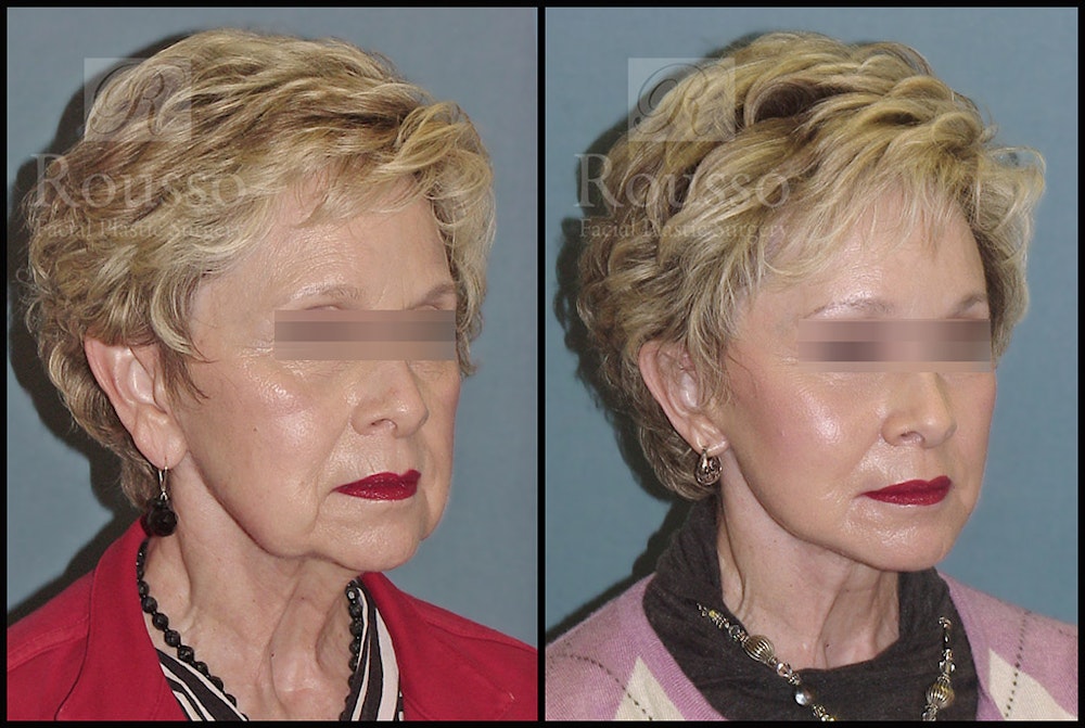 Facelift Before & After Gallery - Patient 2237247 - Image 1