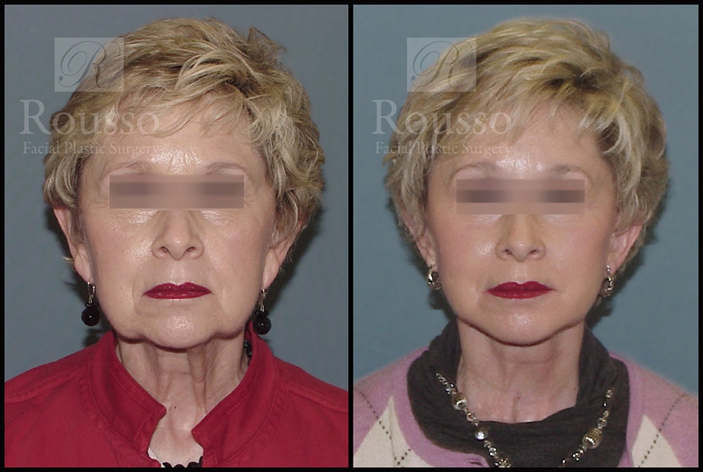 Facelift Before & After Gallery - Patient 2237247 - Image 3