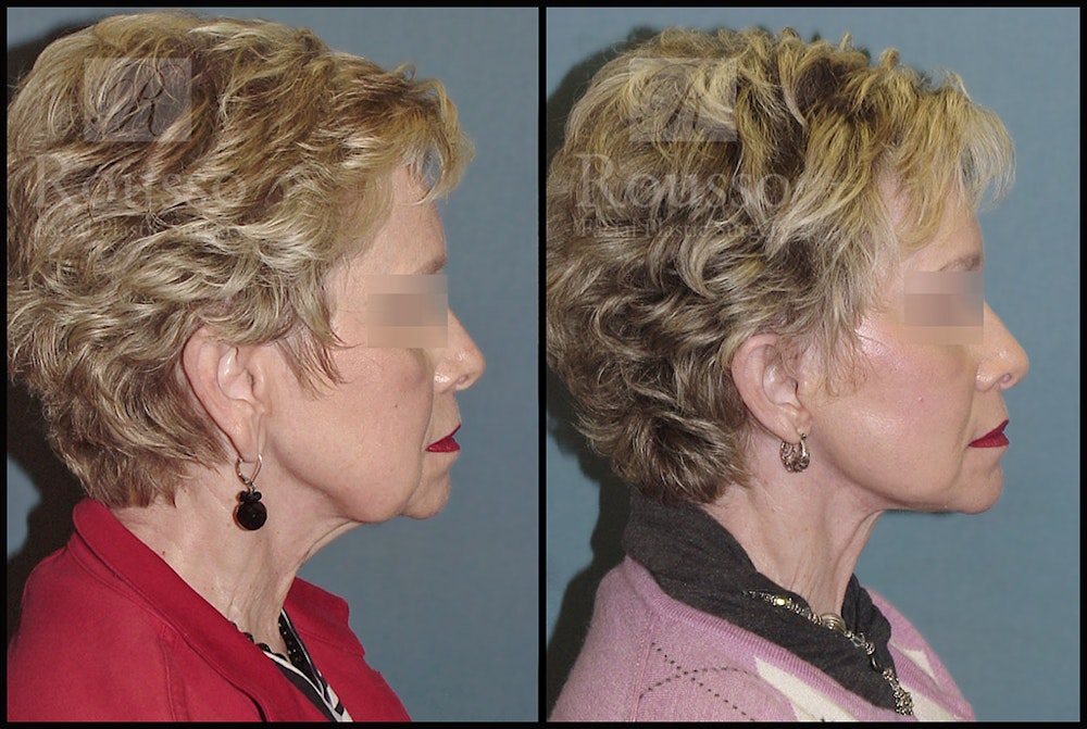 Facelift Before & After Gallery - Patient 2237247 - Image 2