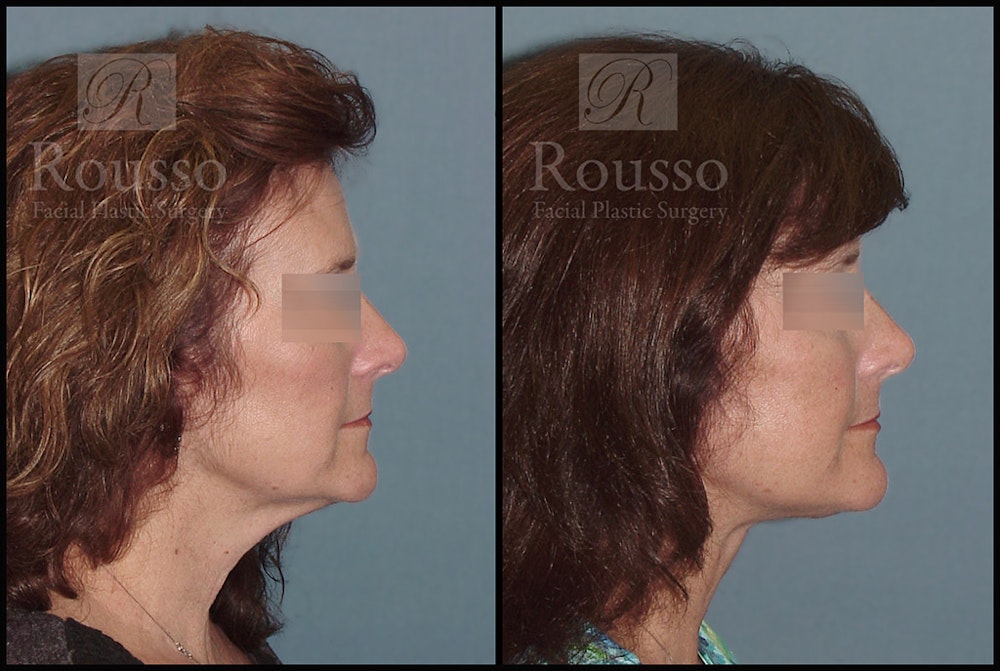 Facelift Before & After Gallery - Patient 2279561 - Image 2