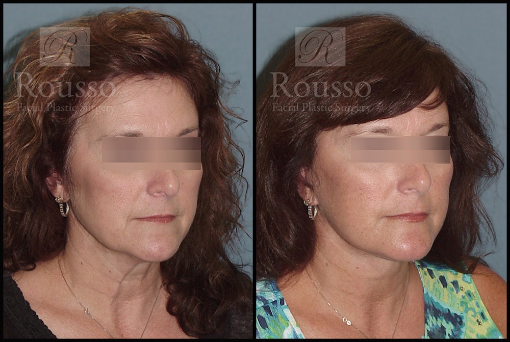 Facelift Before & After Gallery - Patient 2279561 - Image 1
