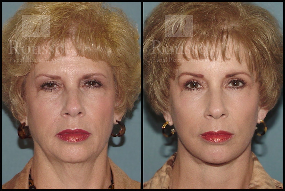 Facelift Before & After Gallery - Patient 4528794 - Image 3