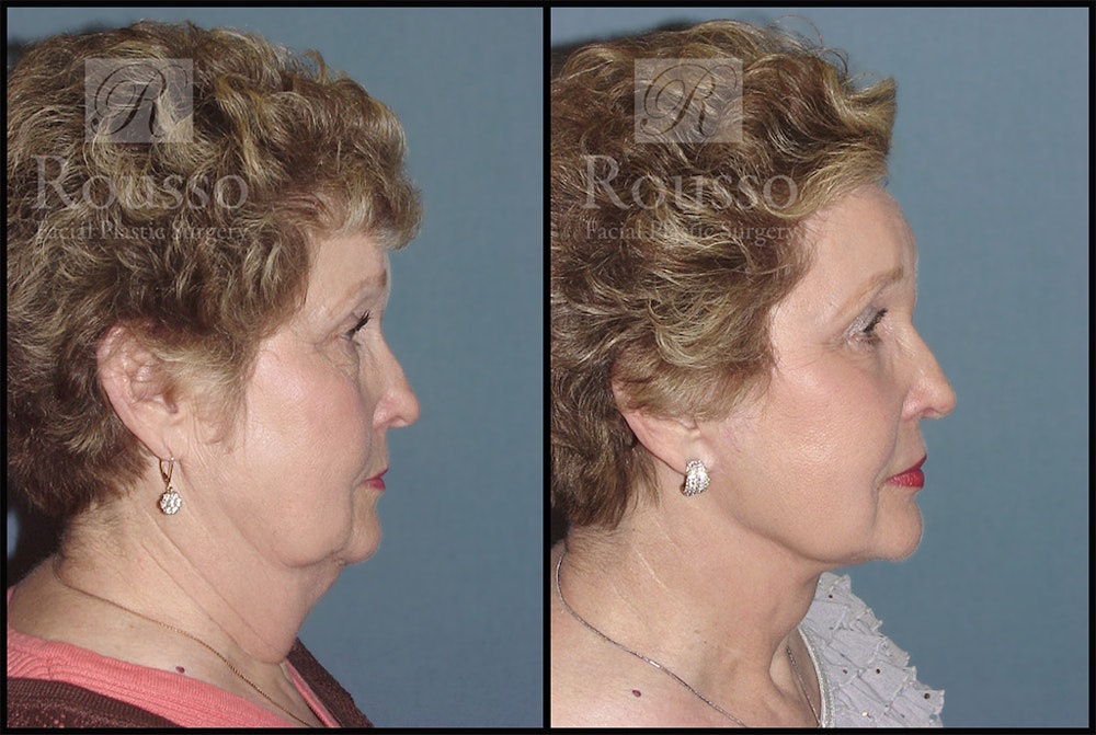 Facelift Before & After Gallery - Patient 4528795 - Image 2