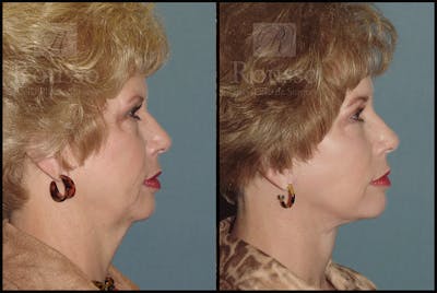 Facelift Before & After Gallery - Patient 4528794 - Image 2