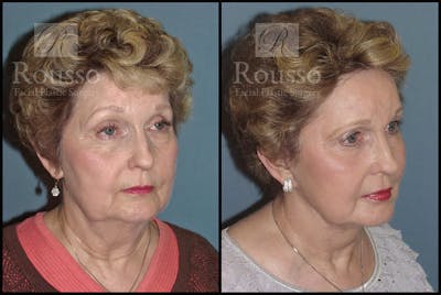 Facelift Before & After Gallery - Patient 4528795 - Image 1