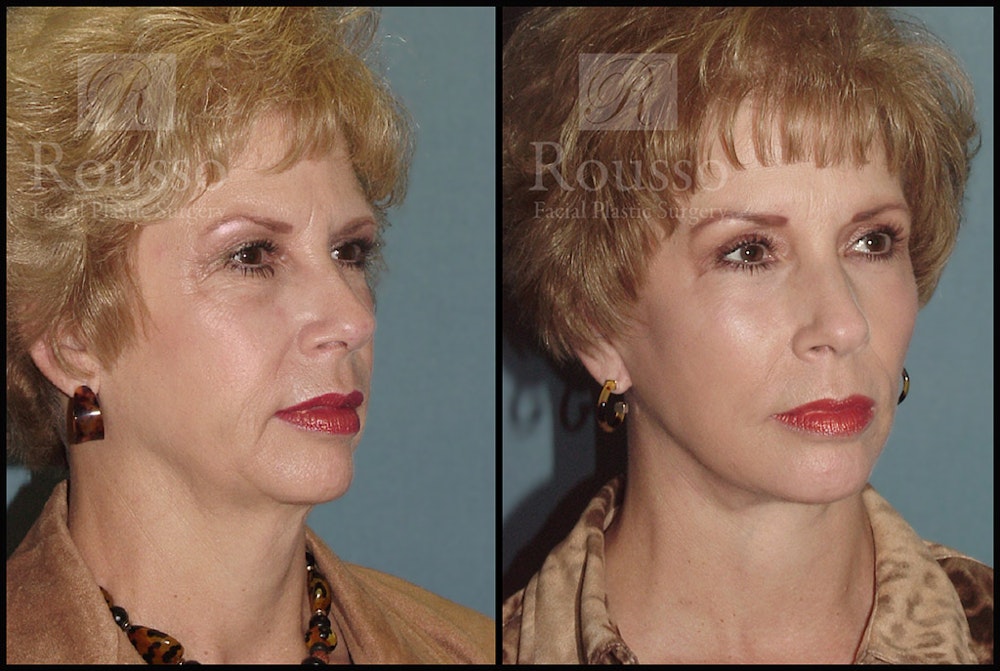 Facelift Before & After Gallery - Patient 4528794 - Image 1