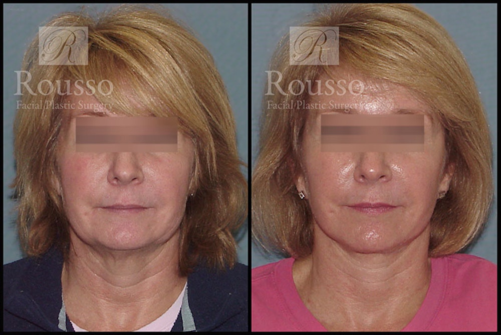MiniLift <span class=small>By Dr. Daniel Rousso</span> Before & After Gallery - Patient 4532282 - Image 1