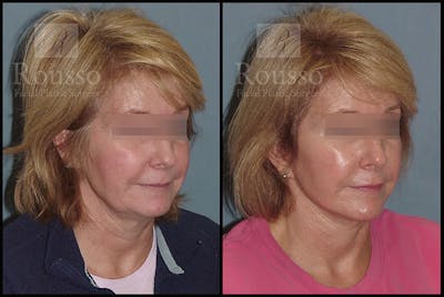 MiniLift <span class=small>By Dr. Daniel Rousso</span> Before & After Gallery - Patient 4532282 - Image 2