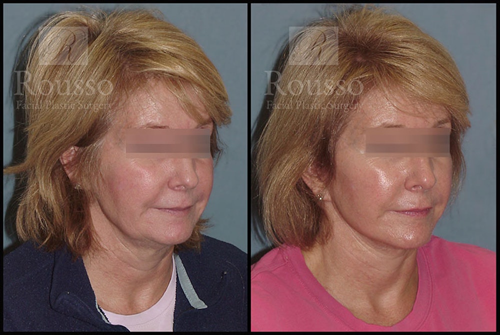 MiniLift <span class=small>By Dr. Daniel Rousso</span> Before & After Gallery - Patient 4532282 - Image 2