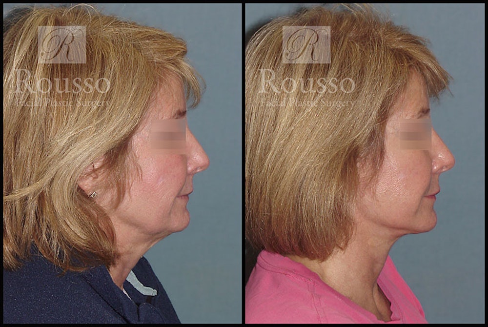 MiniLift <span class=small>By Dr. Daniel Rousso</span> Before & After Gallery - Patient 4532282 - Image 3