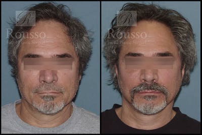 MiniLift Before & After Gallery - Patient 4532283 - Image 1