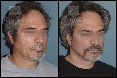 MiniLift Before & After Gallery - Patient 4532283 - Image 2