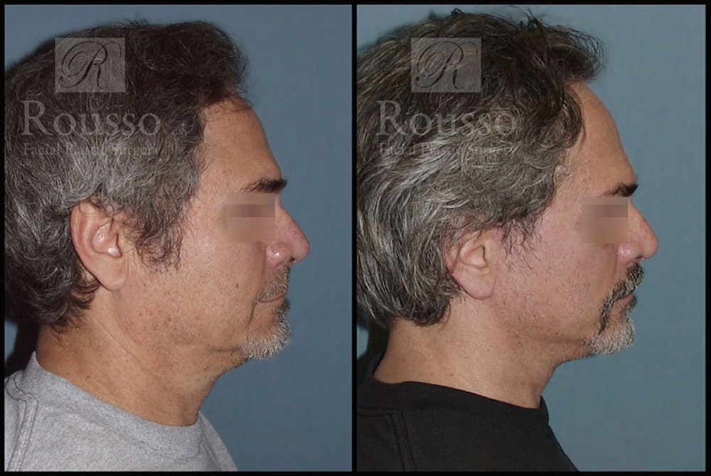 MiniLift Before & After Gallery - Patient 4532283 - Image 3