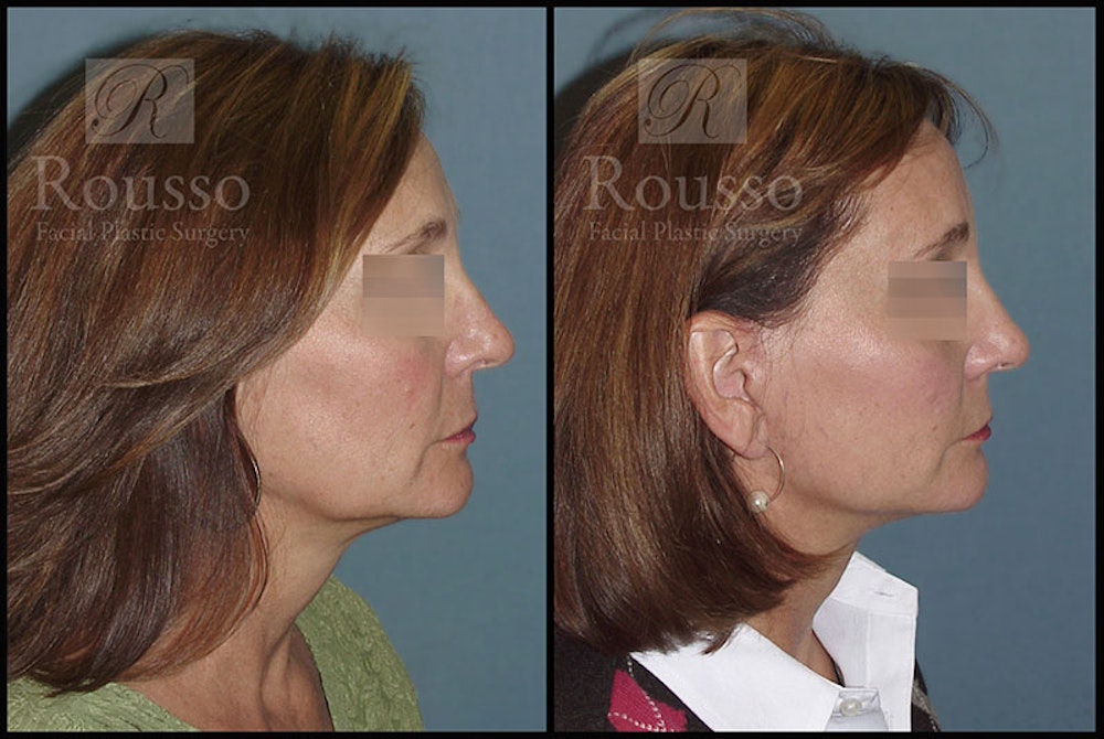 MiniLift Before & After Gallery - Patient 4532284 - Image 3