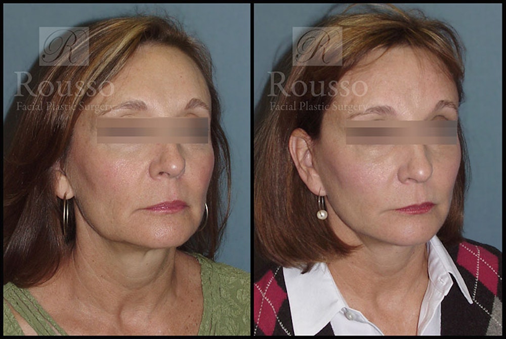MiniLift Before & After Gallery - Patient 4532284 - Image 2