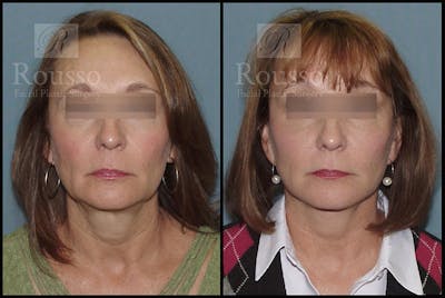 MiniLift <span class=small>By Dr. Daniel Rousso</span> Before & After Gallery - Patient 4532284 - Image 1