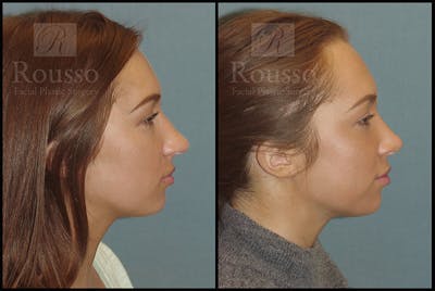 Rhinoplasty Before & After Gallery - Patient 4702352 - Image 1