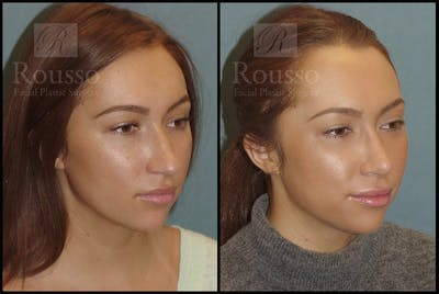 Rhinoplasty Before & After Gallery - Patient 4702352 - Image 1