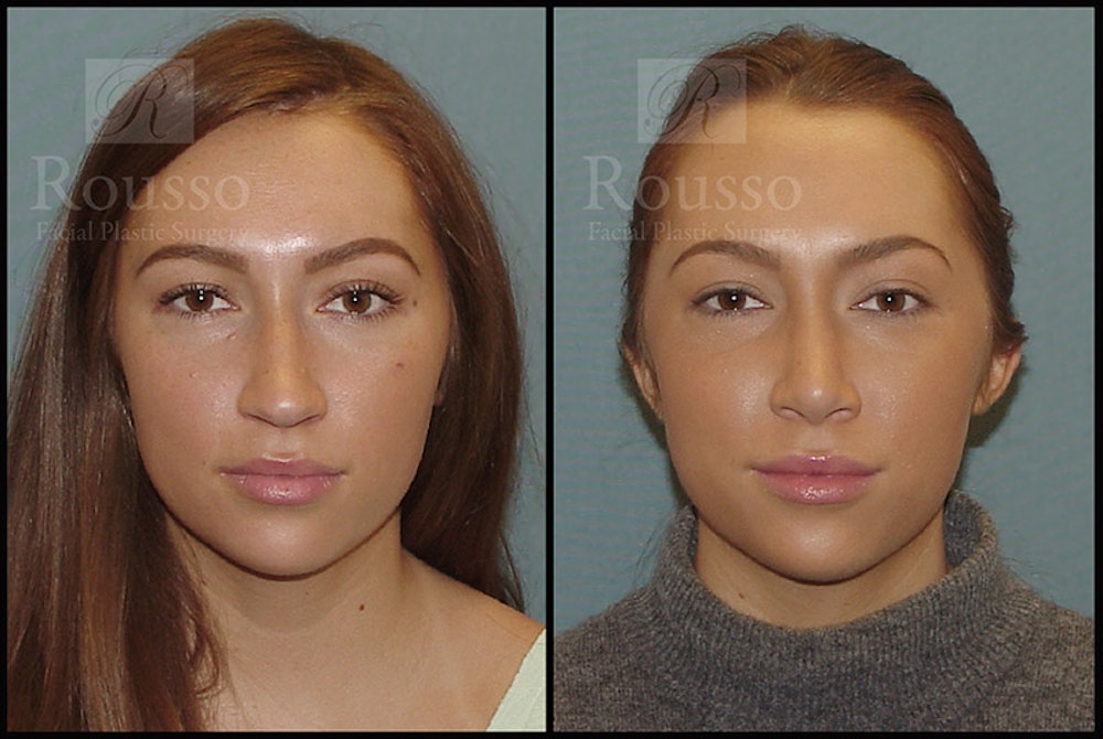 Rhinoplasty Before & After Gallery - Patient 4702352 - Image 3